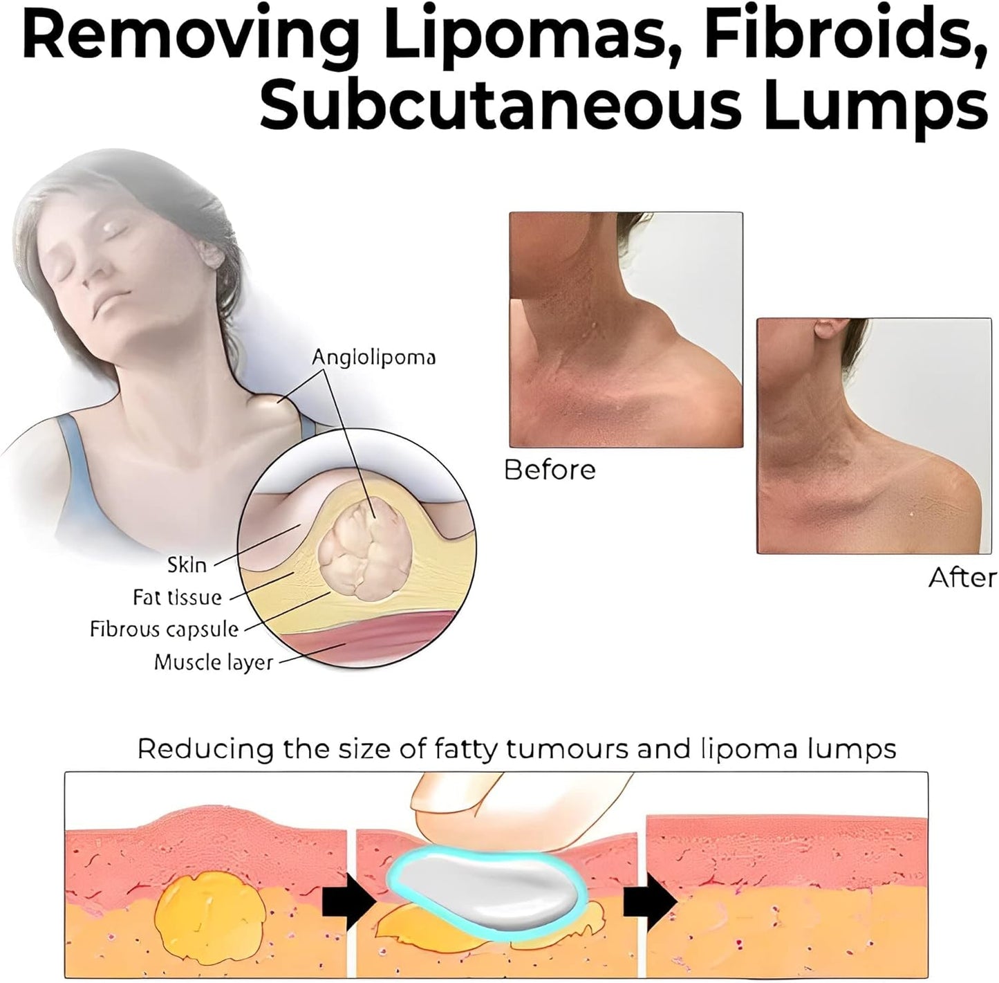 Last Day Of Discount 🔥 Lipoma Removal Cream