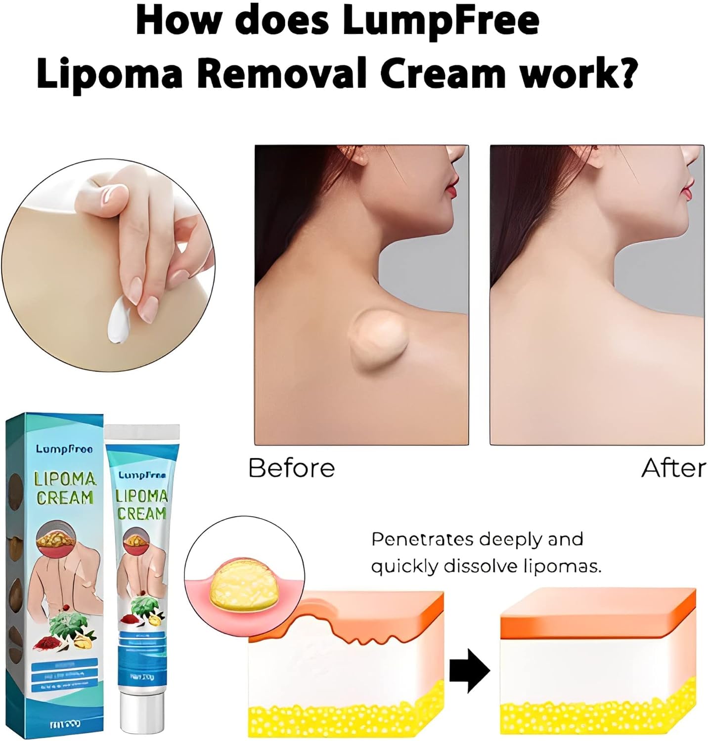 Last Day Of Discount 🔥 Lipoma Removal Cream