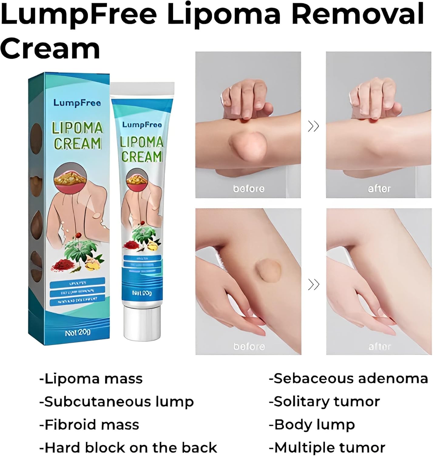 Last Day Of Discount 🔥 Lipoma Removal Cream