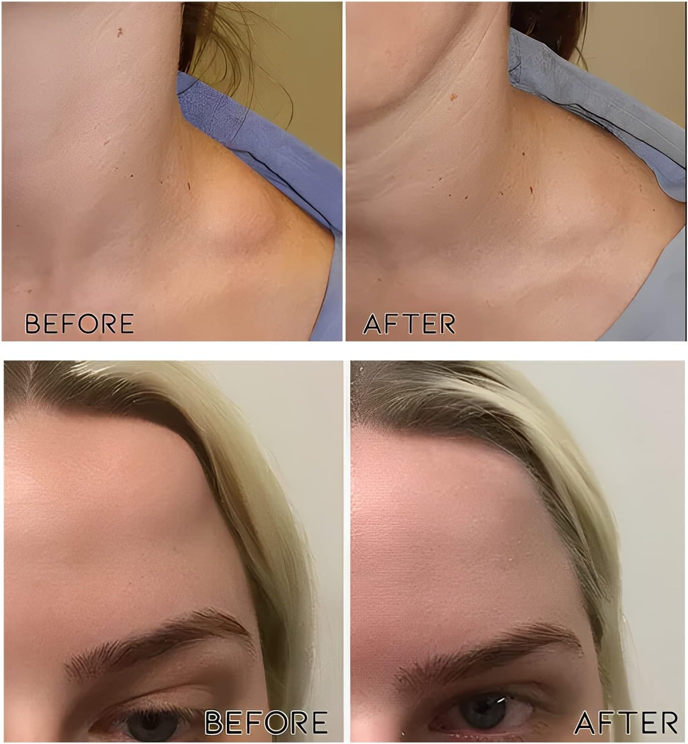 Last Day Of Discount 🔥 Lipoma Removal Cream